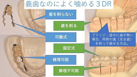 義歯なのによく噛める3DR