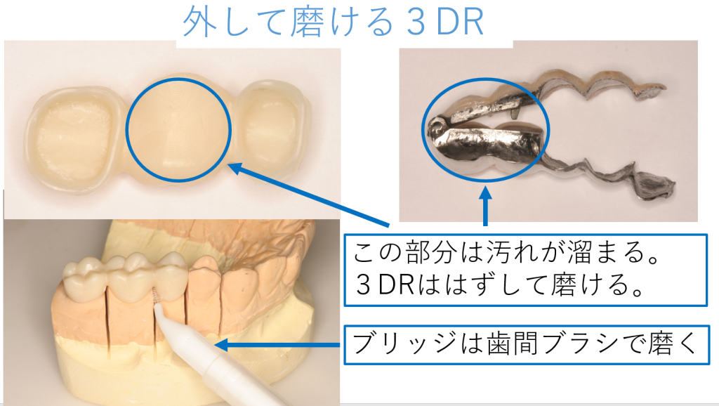 外して磨ける3DR