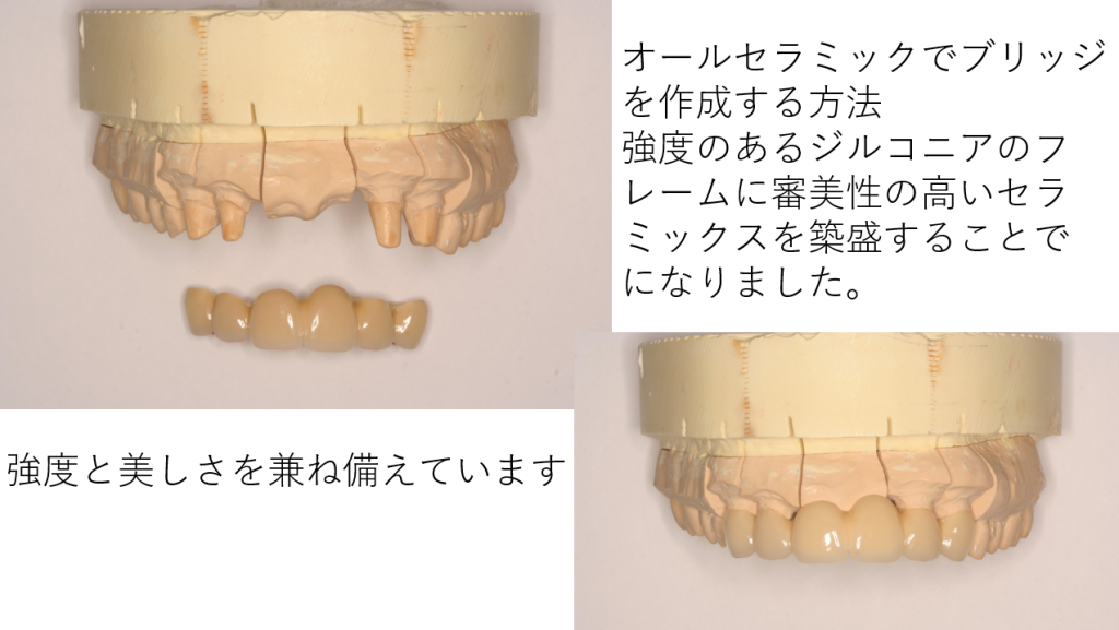 ジルコニアセラミック