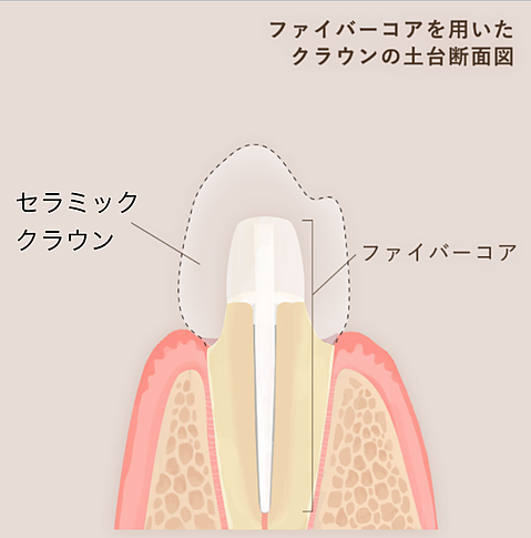 ファイバーコア
