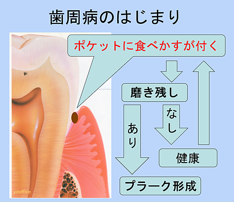 1歯周病のはじまり