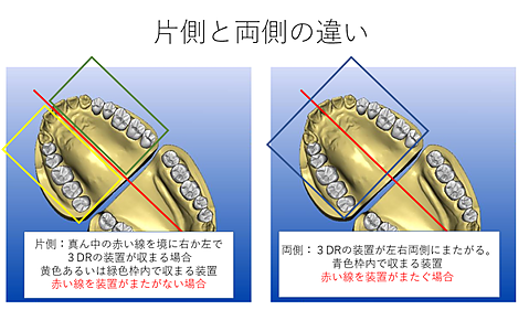 片側と両側