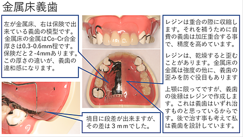 金属床義歯