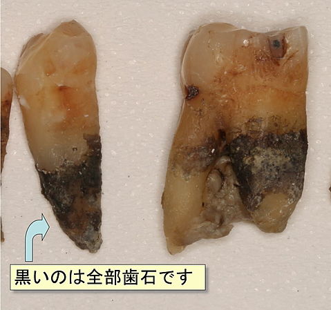 4 歯周病の末期