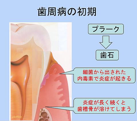 2 歯周病の初期