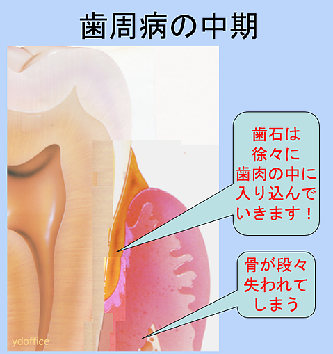 3 歯周病の中期