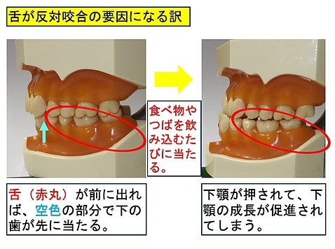 舌が反対咬合の要因になる訳