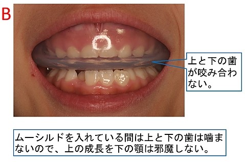 ムーシルドB