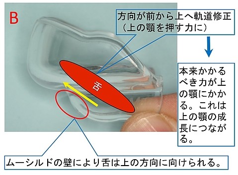 ムー治すB