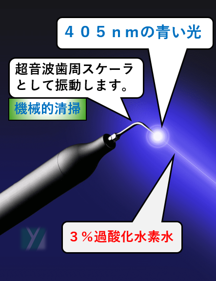 ブルーラジカルは重度の歯周病を治療する医療機器です。ブルーラジカルは先端から３％過酸化水素水とレーザー光が出ます。低侵襲（非外科）で治療可能であるため、患者さんに対する侵襲（痛み、出血、ストレス）が少ない治療法です。