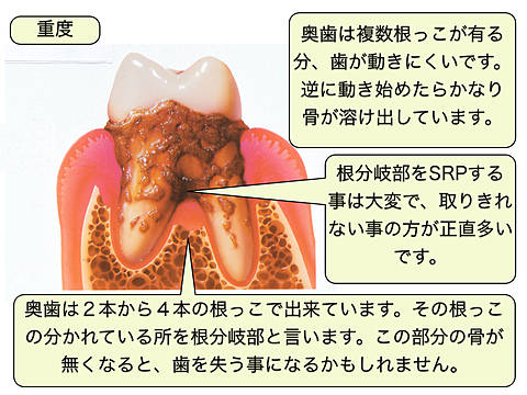重度の歯周病